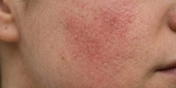 Dermatologista explica de que forma você pode estar machucando sua pele na hora de lavar