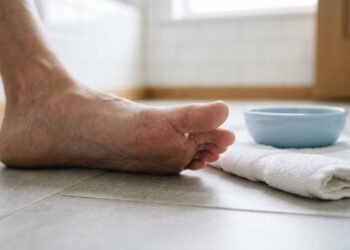 Como eliminar micose nos pés e aliviar coceira e fissuras rapidamente