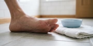 Como eliminar micose nos pés e aliviar coceira e fissuras rapidamente
