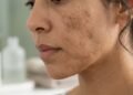 Dermatologistas revelam a rotina que ajuda a evitar manchas e uniformizar a pele o ano inteiro