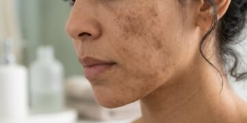 Dermatologistas revelam a rotina que ajuda a evitar manchas e uniformizar a pele o ano inteiro