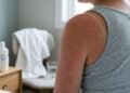 Dermatologistas fazem um alerta à Geração Z: "O bronzeado pode ser o sinal de que a pele sofreu danos causados pelo sol."