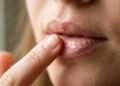 Lábios rachados? 4 soluções baratinhas que ajudam a acabar com o ressecamento