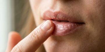 Lábios rachados? 4 soluções baratinhas que ajudam a acabar com o ressecamento