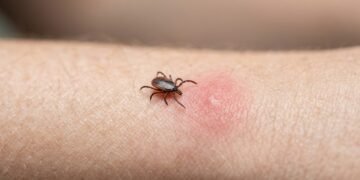 Como se proteger da doença de Lyme, transmitida por carrapatos e que está em ascensão