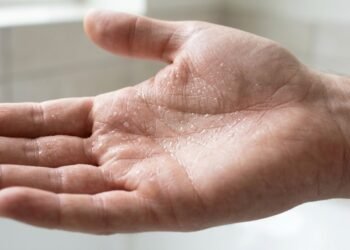 Não é falta de higiene, nem nervosismo demais: dermatologistas mostram que suor nas mãos pode revelar uma condição sem cura