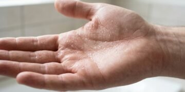 Não é falta de higiene, nem nervosismo demais: dermatologistas mostram que suor nas mãos pode revelar uma condição sem cura