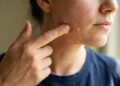 Dermatologistas alertam para o perigo de usar limão na pele, especialmente durante o verão