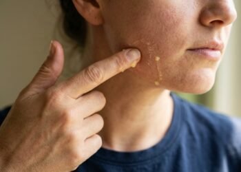 Dermatologistas alertam para o perigo de usar limão na pele, especialmente durante o verão