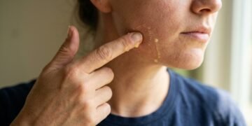 Dermatologistas alertam para o perigo de usar limão na pele, especialmente durante o verão