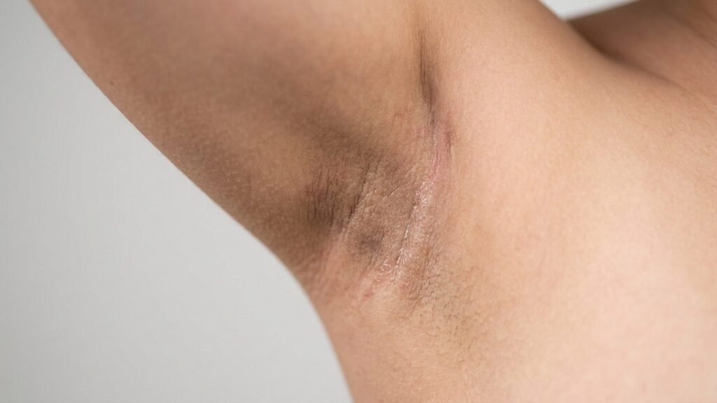 Pare de usar limão e bicarbonato para clarear as axilas: dermatologista explica por que eles podem piorar as manchas