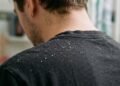 Nem falta de higiene, nem doença contagiosa: o que realmente provoca a caspa