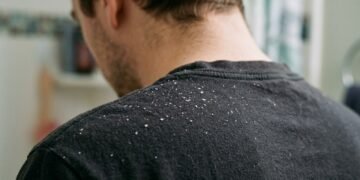 Nem falta de higiene, nem doença contagiosa: o que realmente provoca a caspa