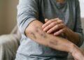 Hematomas que aparecem sem motivo podem indicar problemas no sangue e exigem atenção
