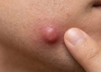 Nem espremer, nem furar: o que fazer quando a espinha interna dói antes mesmo de aparecer