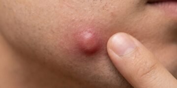 Nem espremer, nem furar: o que fazer quando a espinha interna dói antes mesmo de aparecer