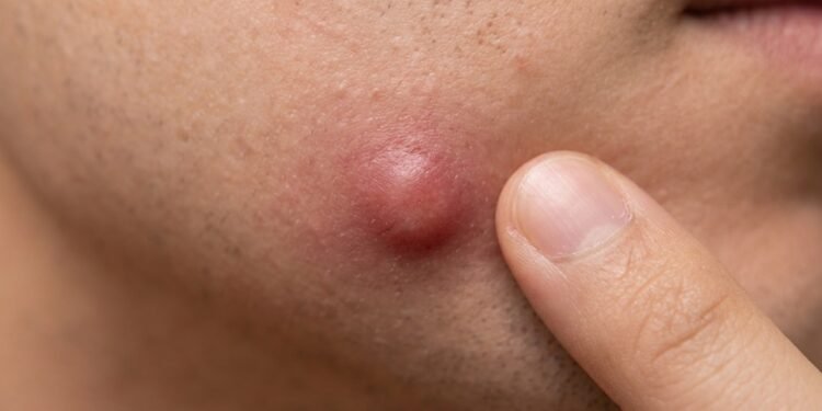 Nem espremer, nem furar: o que fazer quando a espinha interna dói antes mesmo de aparecer