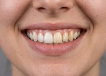 Esses são os melhores alimentos que irão ajudar a clarear seus dentes de forma natural