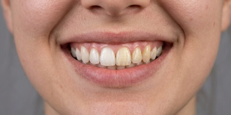 Esses são os melhores alimentos que irão ajudar a clarear seus dentes de forma natural