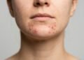 Espinhas no queixo podem revelar mais do que excesso de oleosidade: estes sinais indicam possíveis alterações hormonais
