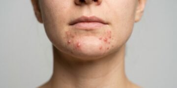Espinhas no queixo podem revelar mais do que excesso de oleosidade: estes sinais indicam possíveis alterações hormonais