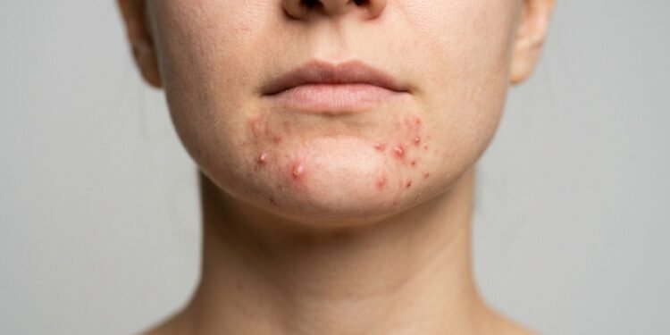 Espinhas no queixo podem revelar mais do que excesso de oleosidade: estes sinais indicam possíveis alterações hormonais