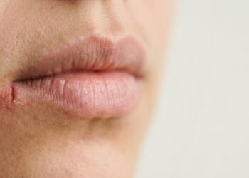 Nem falta de higiene, nem simples ressecamento: a rachadura no canto da boca pode ter outras causas