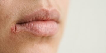 Nem falta de higiene, nem simples ressecamento: a rachadura no canto da boca pode ter outras causas
