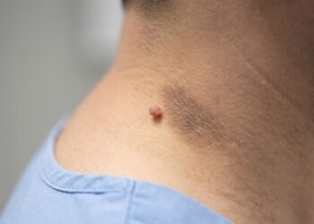 Entenda quando as marcas na pele são um sinal de diabetes