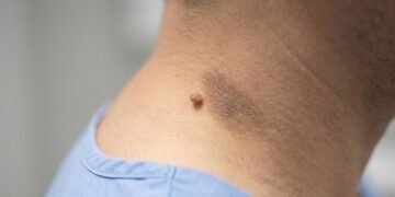 Entenda quando as marcas na pele são um sinal de diabetes