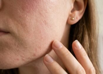 Começou a usar retinol e a pele piorou? Entenda quando isso é adaptação e quando é sinal de irritação perigosa