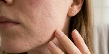 Começou a usar retinol e a pele piorou? Entenda quando isso é adaptação e quando é sinal de irritação perigosa