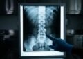 Paciente faz cirurgia na coluna, passa a sentir fortes dores e descobre pedaço de pinça esquecido no corpo: Justiça manda médico, hospital e plano pagarem R$ 50 mil