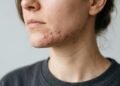 Saiba identificar se você tem acne hormonal e como se livrar dela