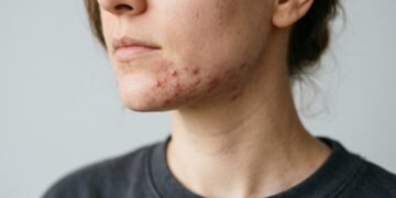 Saiba identificar se você tem acne hormonal e como se livrar dela