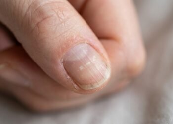 O que suas unhas estão tentando avisar quando mudam de cor, quebram fácil ou aparecem com marcas estranhas
