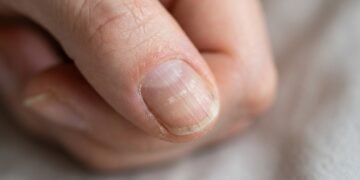 O que suas unhas estão tentando avisar quando mudam de cor, quebram fácil ou aparecem com marcas estranhas